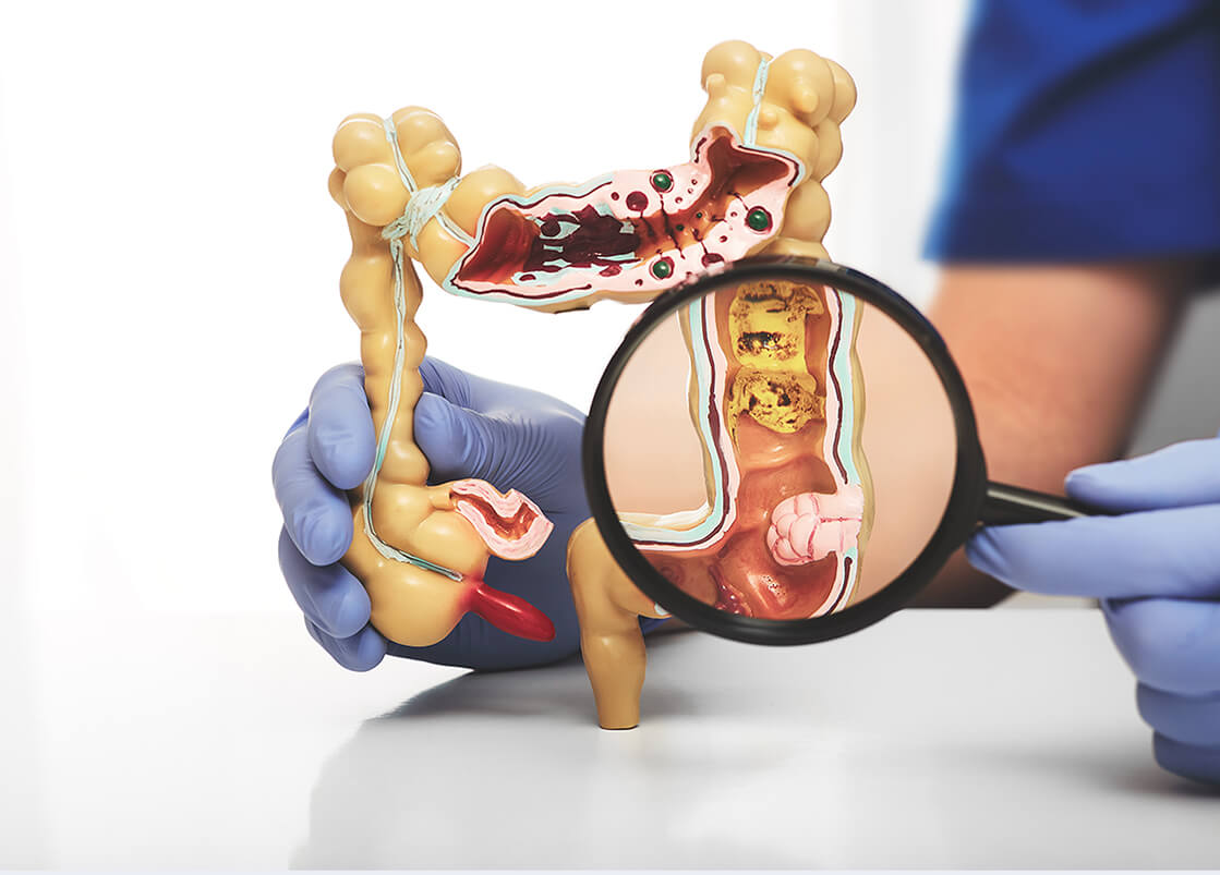 colorectal surgery in India